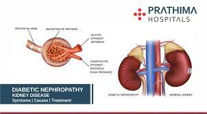 Check spelling or type a new query. Diabetic Kidney Disease Dkd Symptoms Diagnosis And Treatment Best Hospital In Hyderabad Best Hospital In Kukatpally Kachiguda