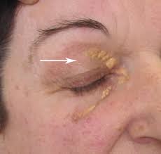 Image result for xantelasma