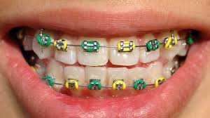Dental Braces Braket
