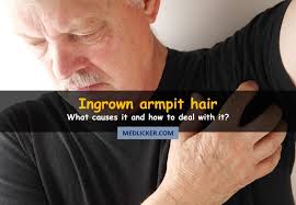 Ingrown armpit hair is a common condition especially for most ladies and some men. Ingrown Underarm Hair Treatment Prevention More