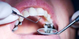 Check spelling or type a new query. How Can You Get Rid Of Cavities And Is That Even Possible