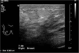 We'll show you breast cancer pictures to help you identify any physical traits of the condition. Right Breast Ultrasound Showing Skin Thickening And Underlying Marked Download Scientific Diagram