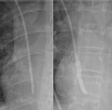 A central venous catheter is a tube that goes into a vein in your arm or chest and ends at the right side of your heart (right atrium). Central Venous Catheter Wikipedia