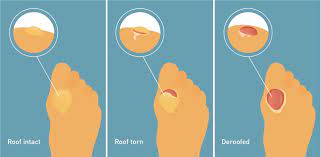 How To Treat Blisters – The Right Way | Live Better