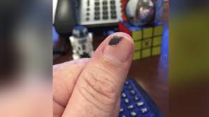 Bluterguss Unter Dem Fingernagel So Geht Der Korper Damit Um