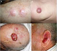 We encourage you to make connections; A Clinical Presentation Of Merkel Cell Carcinoma In 4 Patients In The Download Scientific Diagram