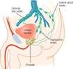 Stage 4 Prostate Cancer Lymph Nodes