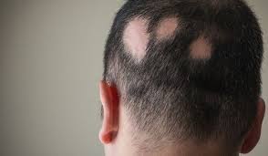 Solution contre la chute de cheveux ou perte de cheveux; Pelade