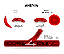Sickle cell disease is a condition in which red blood cells are not shaped as they should be. About Sickle Cell Disease