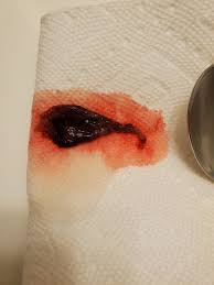 Passing tissue may be a sign of miscarriage. Early Miscarriage Picture Warning May 2021 Babies Forums What To Expect