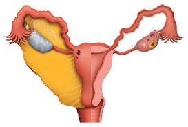 Endometriosis Staging The Four Stages Of Endometriosis