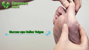 как лечить косточку на ноге в домашних условиях отзывы Massazh Pri Halyus Valgus Hallux Valgus 10 Tehnik V Kartinkah