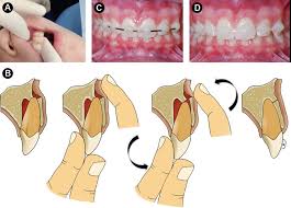 Image result for Tooth Luxation