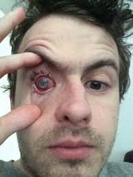 We consider you to be blind if your vision can't be corrected to better than 20/200 in your better eye or if your visual field is 20 degrees or less in I Almost Went Blind After A Parasite Bored Into My Eye When I Went Swimming In Contact Lenses