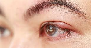 Here's some information to help you get ready. What Is A Stye Silverstein Eye Centers Silverstein Eye Centers