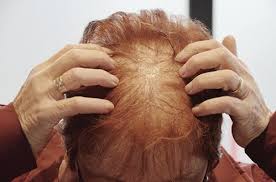 I am 69 and took avodart for 13 years. Non Ablative Er Yag Laser Treatment Of Female Patterned Hair Loss The Pmfa Journal