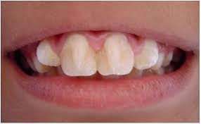 What Is Talon Cusp And Dens Evaginatus News Healthy Teeth Dental Teeth