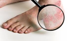 It can be hard to tell the difference between bone metastasis pain and pain due to arthritis or an exercise strain. What Is Plantar Fasciitis Symptoms Causes Diagnosis Treatment And Prevention Everyday Health