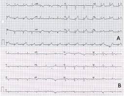 La miocarditis es la inflamación del músculo cardíaco (miocardio). Miocarditis Aguda Tras Administracion De Vacuna Bnt162b2 Contra La Covid 19 Revista Espanola De Cardiologia