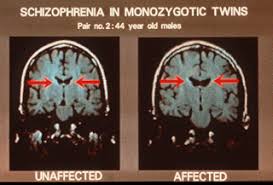 Simple schizophrenia, simple deteriorative disorder, schizophrenia simplex, deficit schizophrenia the simplex type was added by eugen bleuler to the earlier ones identified by kraepelin in 1899 and. Schizophrenia Wikiwand
