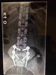 Laminectomy Spinal Fusion Fbss Failed Back Surgery Syndrome Yes This Is Me Jointpainrelief Spinal Fusion Back Surgery Spinal