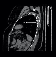 Image result for Broncholithiasis