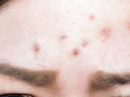 Skin cancer is the most common type of cancer in the united states by a pretty large margin, and it does not discriminate. Bump On Forehead 7 Causes And Treatment