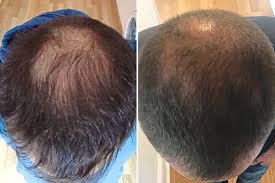 By jessica firger on 4/29/16 at 12:56 pm edt. Baldness Could Be Cured With A 2 000 Treatment That Reverses Hair Loss Experts Say