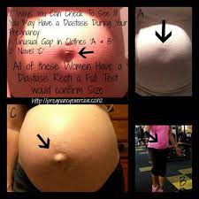 How do you know if you have diastasis recti. How To Test For Diastasis Recti During Pregnancy Pregnancy