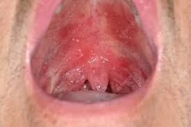 Image result for Oral thrush roof of mouth