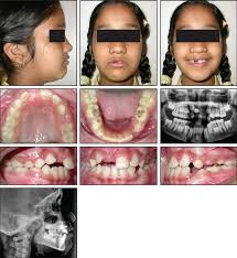 Interventions for promoting the eruption of palatally displaced permanent. Eruption And Alignment Of Impacted Teeth With Multi Purpose Attachments Jco Online Journal Of Clinical Orthodontics