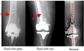 Medial epicondyle fracture and not medial condyle fracture!!! Distal Femur Thighbone Fractures Of The Knee Orthoinfo Aaos