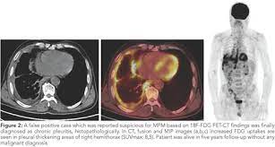 Scanning (positron emission tomography) is one of the most advanced imaging and diagnostic techniques in modern medicine. The Role Of 18f Fdg Pet Ct In Diagnosis And Prediction Of Prognosis In Malignant Pleural Mesothelioma Malign Plevral Mezotelyoma Ayirici Tanisi Ve Prognozunda 18f Fdg Pet Bt Nin Rolu Document Gale Onefile Health And Medicine