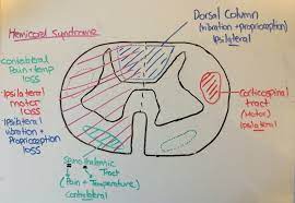 A Boring Guide To Spinal Cord Syndromes Canadiem