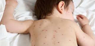 We did not find results for: Varicelle Symptome Incubation Contagion Traitement Mpedia Fr