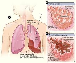 Betul ke mandi malam penyebab paru paru berair. Adakah Radang Paru Paru Atau Pneumonia Menular Sihat Net