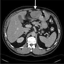 When cancerous tumors form on connective tissues, it is a sarcoma. Prognostic Role Of Radiological Peritoneal Cancer Index In Malignant Peritoneal Mesothelioma National Cohort Study Scientific Reports