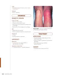 Image result for Septic Joint