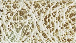 The food that you eat can affect your bones. Risk Factors Of Osteoporosis