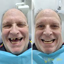 Treatment in Los Algodones (Mexico)