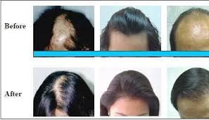 Once they have evaluated the cause, they prescribe a suitable homeopathic medicine. Homeopathic Treatment For Hair Disease