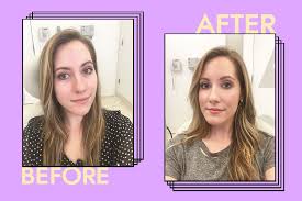 Maybe you would like to learn more about one of these? I Got Restylane Fillers For The First Time