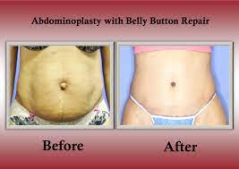 Pin On Abdominoplasty Tummy Tuck