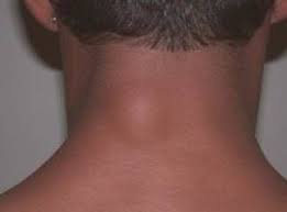 sifali bitkilerim hastaliklar yag bezeleri lipom