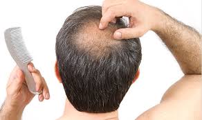 Sometimes, coming off a medication can cause hair loss. Hair Loss Cure Experts Reveals What Can Stop Balding Express Co Uk