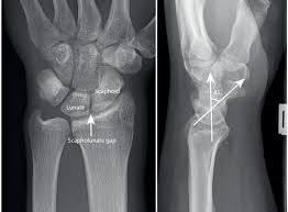 Image result for Scapholunate Dislocation