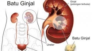Saluran perkemihan terdiri dari ginjal, ureter, vesika urinaria dan urethra. 7 Minuman Untuk Bersihkan Ginjal Secara Alami Salah Satunya Dengan Teh Jahe Tribun Solo
