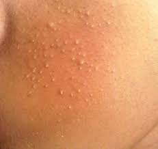 In some cases, small raised white spots can appear on face after shaving. Whiteheads On The Face White Bumps On Face Skin Tag On Eyelid Weird Beauty Hacks