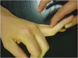 L'arthrose des doigts affecte principalement les femmes, aux alentours de la ménopause. Lesions Ligamentaires Entorses Et Luxations Des Doigts Longs La Medecine Du Sport