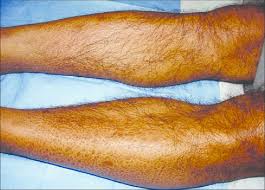 Effects of xerosis and ageing on epidermal proliferation and differentiation. Xerosis Secondary To Renal Failure Download Scientific Diagram